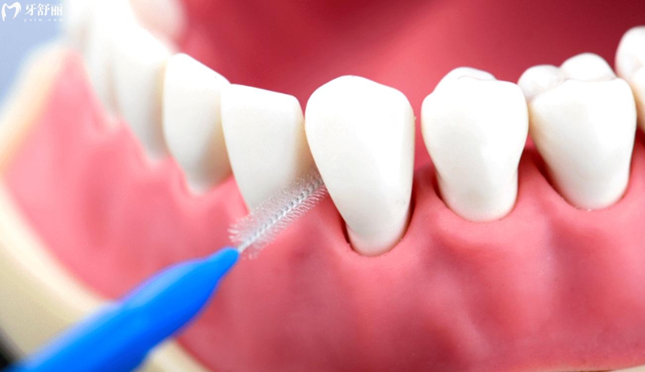 清洁牙齿的小工具.jpg 清洁牙齿的小工具.jpg