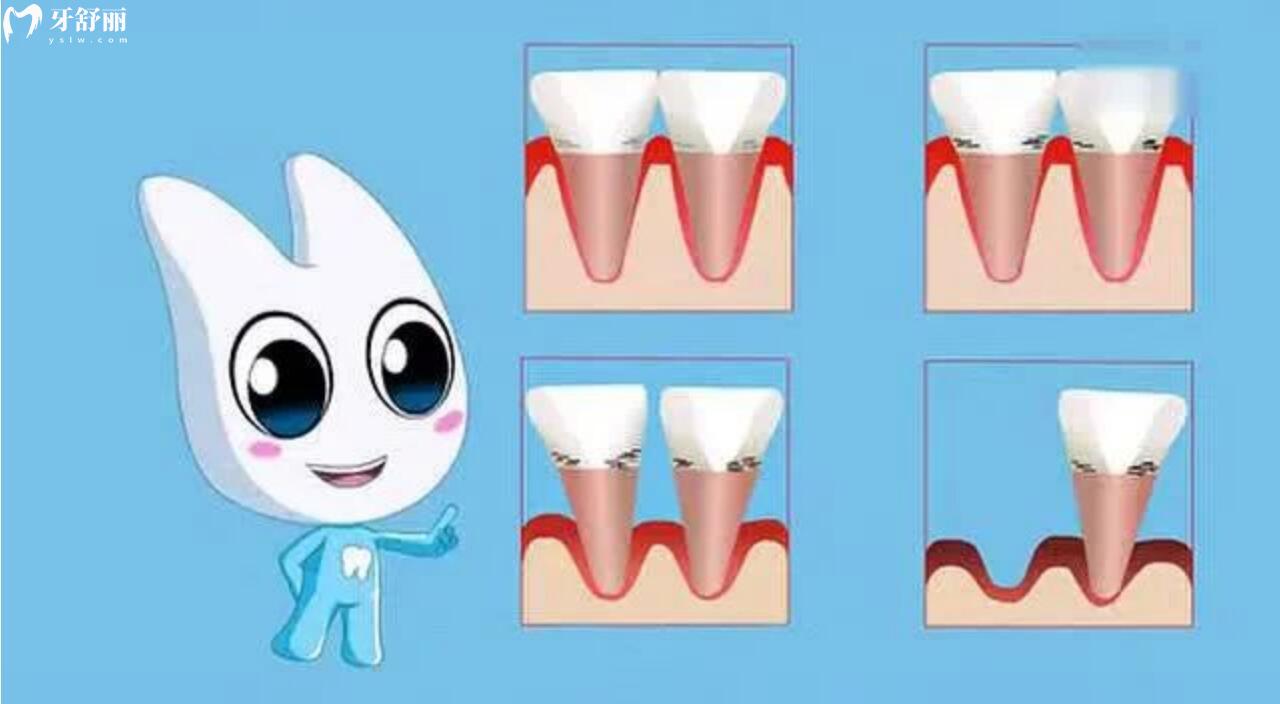 牙周炎牙龈萎缩牙齿松动移位怎么办呢?快来看看牙医怎么说 牙周炎牙龈萎缩牙齿松动移位怎么办呢?快来看看牙医怎么说