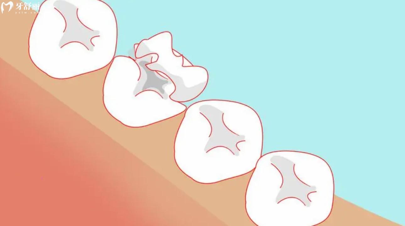 科尔树脂补牙能用多久?来看看它怎么样?型号有哪些?