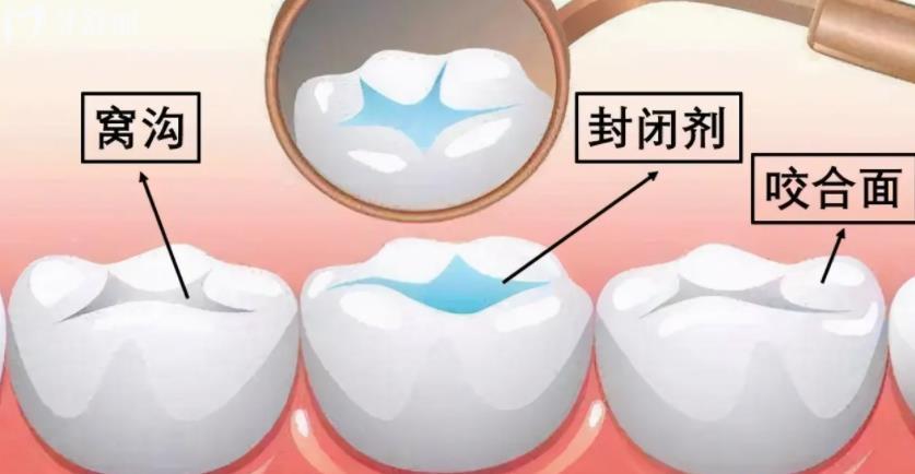 几分钟的牙齿涂氟有作用吗？和窝沟封闭有什么区别？