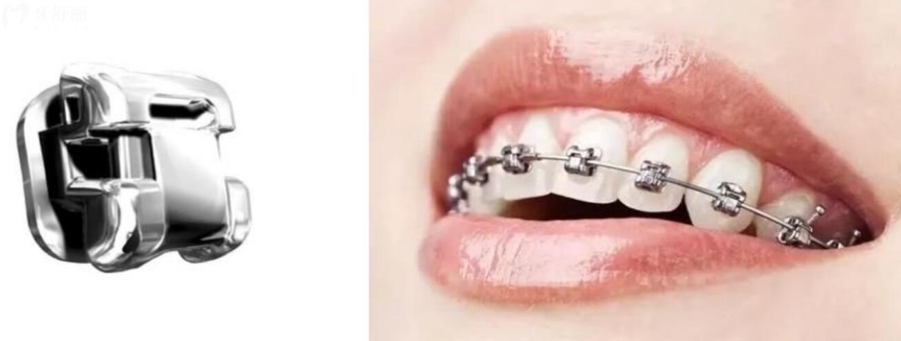 自锁牙套和普通牙套有什么区别弊端在哪里?一起来了解下 自锁牙套和普通牙套有什么区别弊端在哪里?一起来了解下