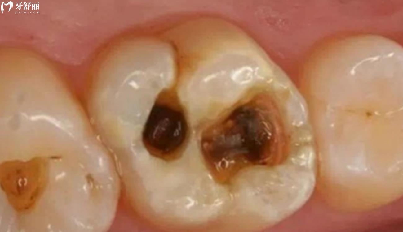 牙齿坏了一半里面都空了怎么办.jpg 牙齿坏了一半里面都空了怎么办.jpg