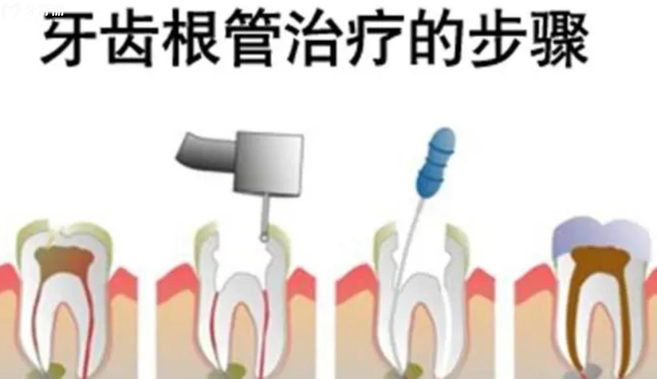 牙齿坏了一半里面都空了怎么办.jpg 牙齿坏了一半里面都空了怎么办.jpg