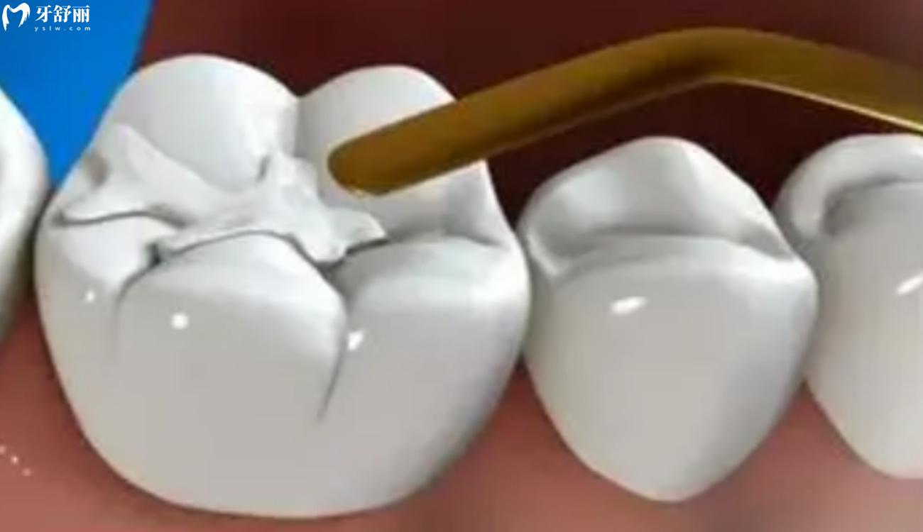 牙齿坏了一半里面都空了怎么办.jpg 牙齿坏了一半里面都空了怎么办.jpg