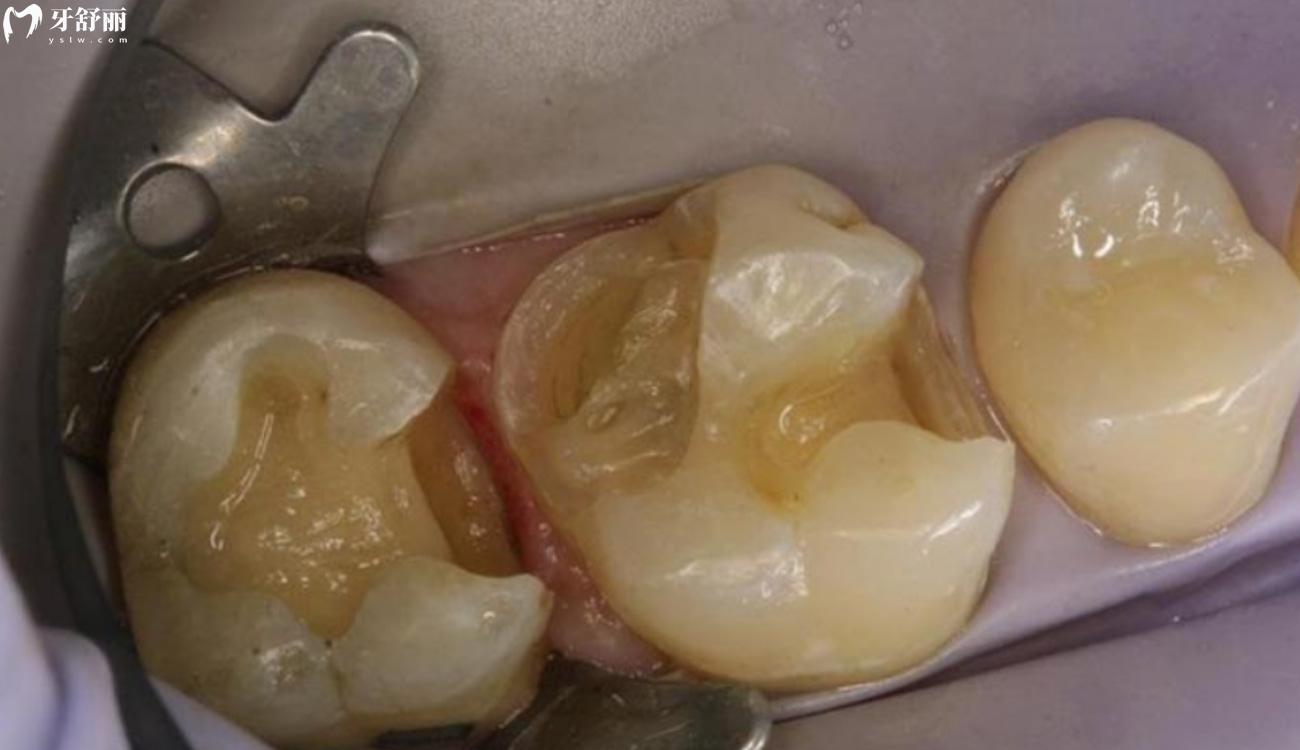 牙齿坏了一半里面都空了怎么办.jpg 牙齿坏了一半里面都空了怎么办.jpg