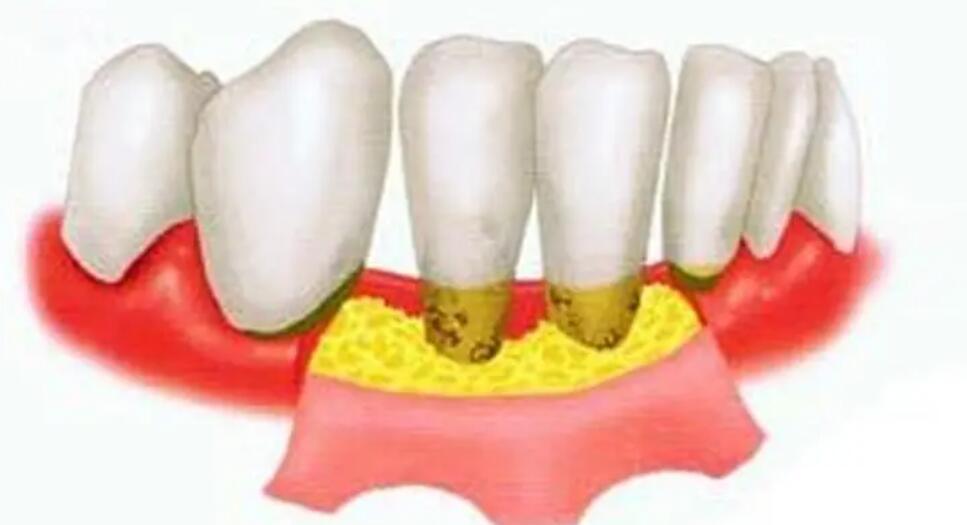 牙周炎治疗费用大概多少 牙周炎治疗费用大概多少