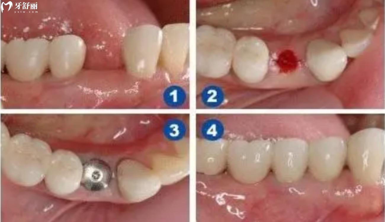 种植牙才2980元靠谱吗.jpg 种植牙才2980元靠谱吗.jpg