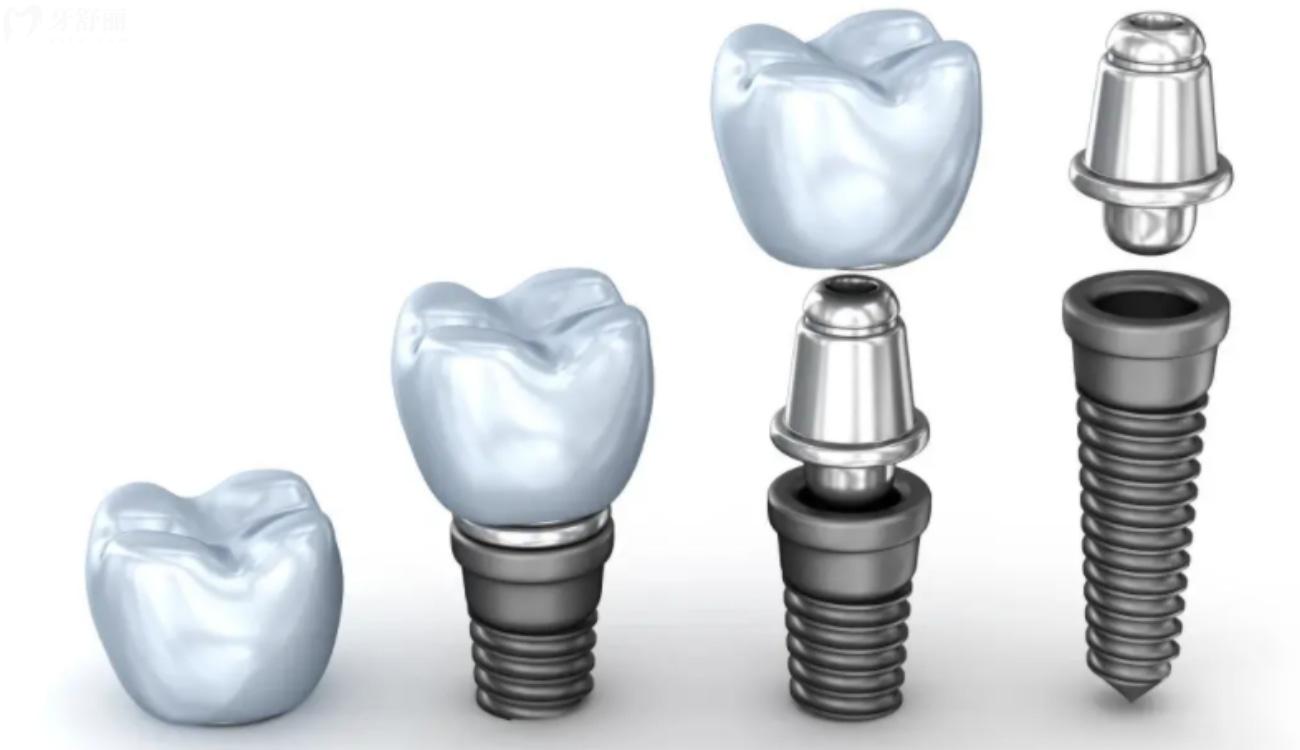 种植牙才2980元靠谱吗.jpg 种植牙才2980元靠谱吗.jpg