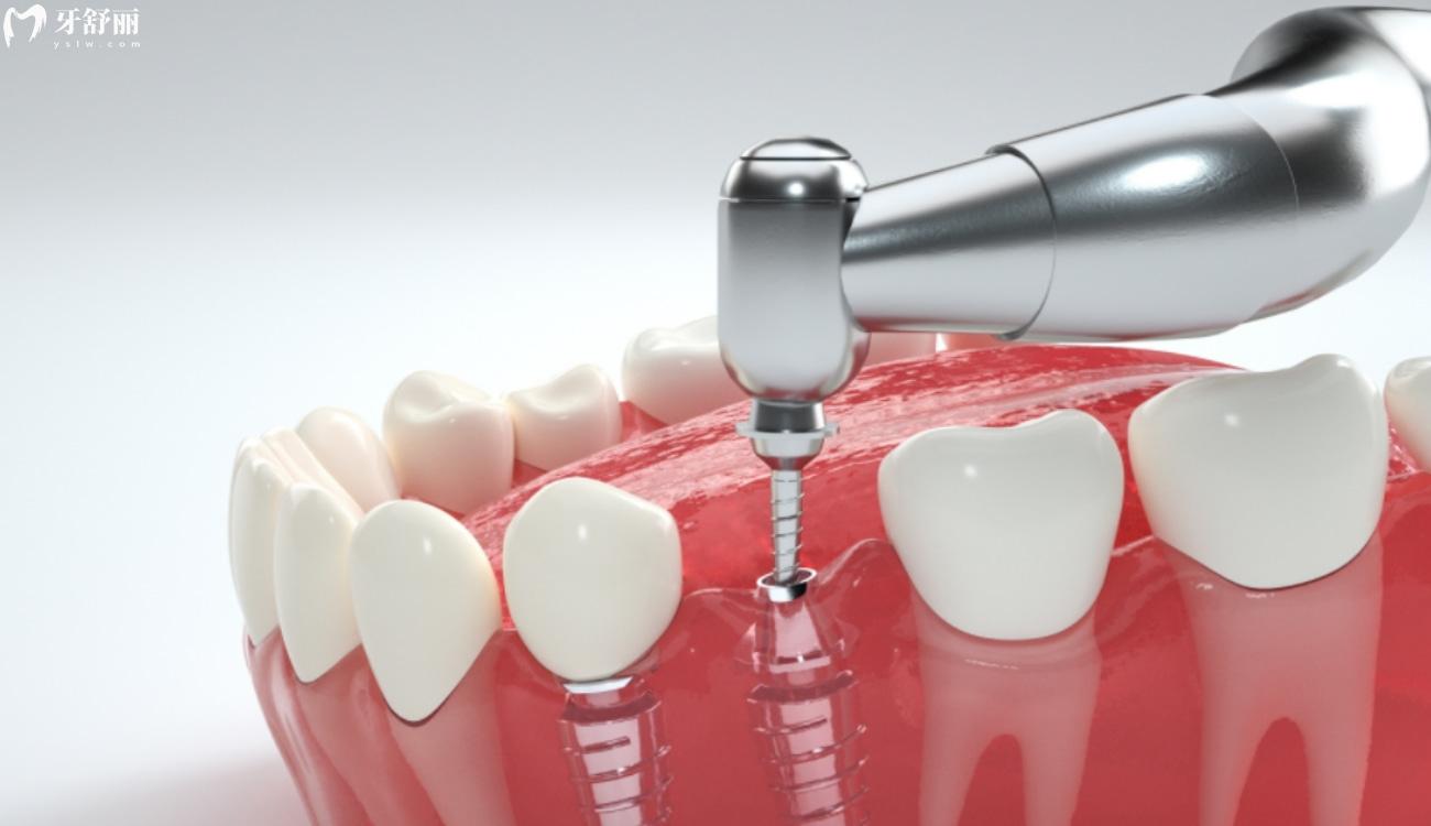 种植牙才2980元靠谱吗.jpg 种植牙才2980元靠谱吗.jpg