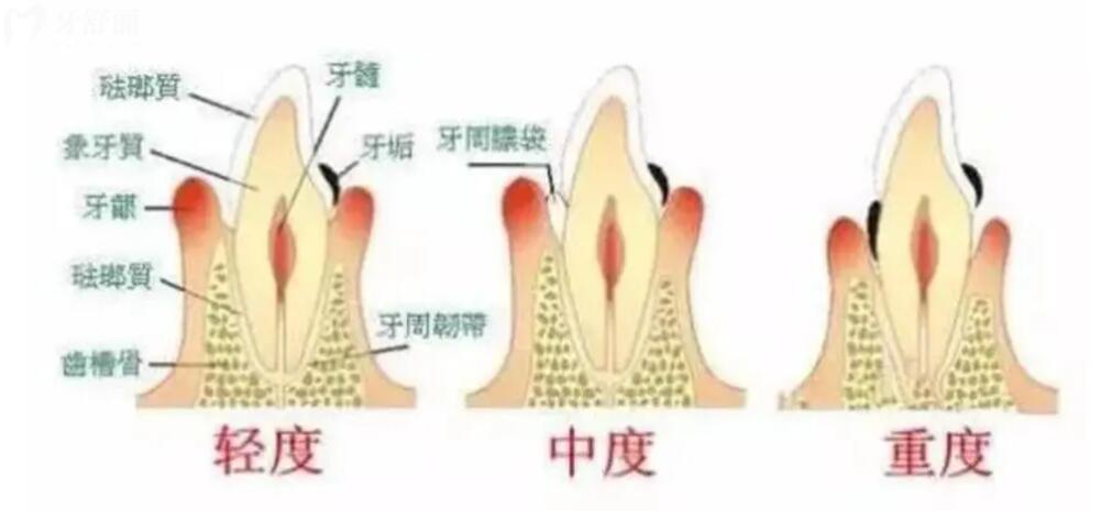 牙龈萎缩牙根外露怎么修复 牙龈萎缩牙根外露怎么修复