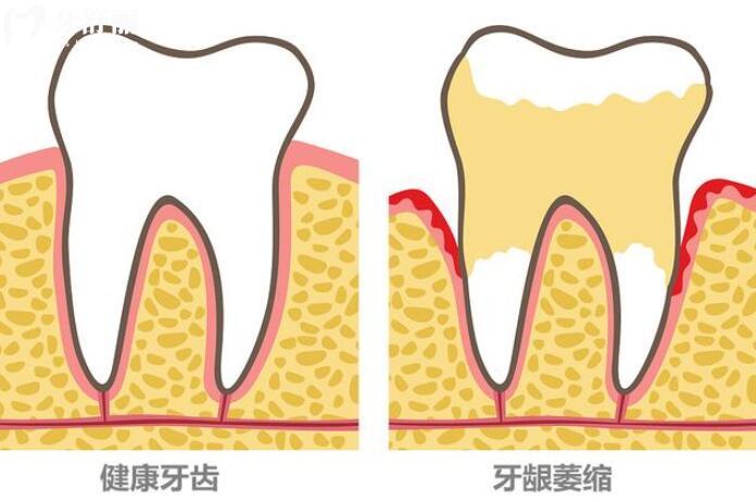牙龈萎缩牙根外露怎么修复 牙龈萎缩牙根外露怎么修复