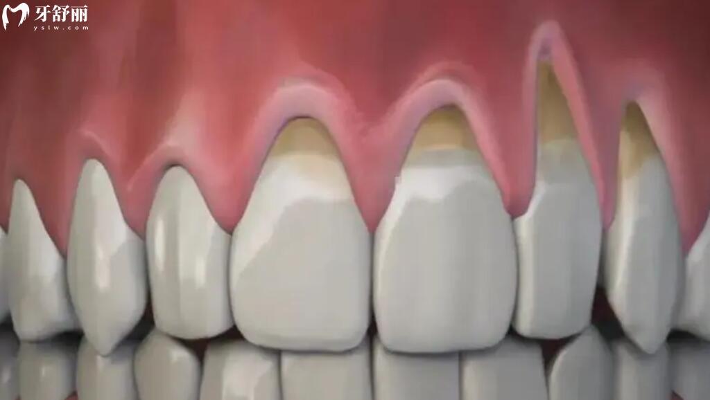 牙龈萎缩牙根外露怎么修复 牙龈萎缩牙根外露怎么修复