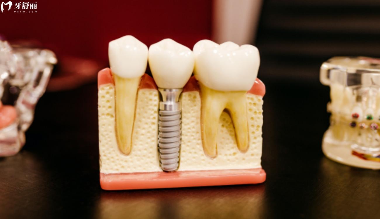 全口假牙价目表.jpg 全口假牙价目表.jpg