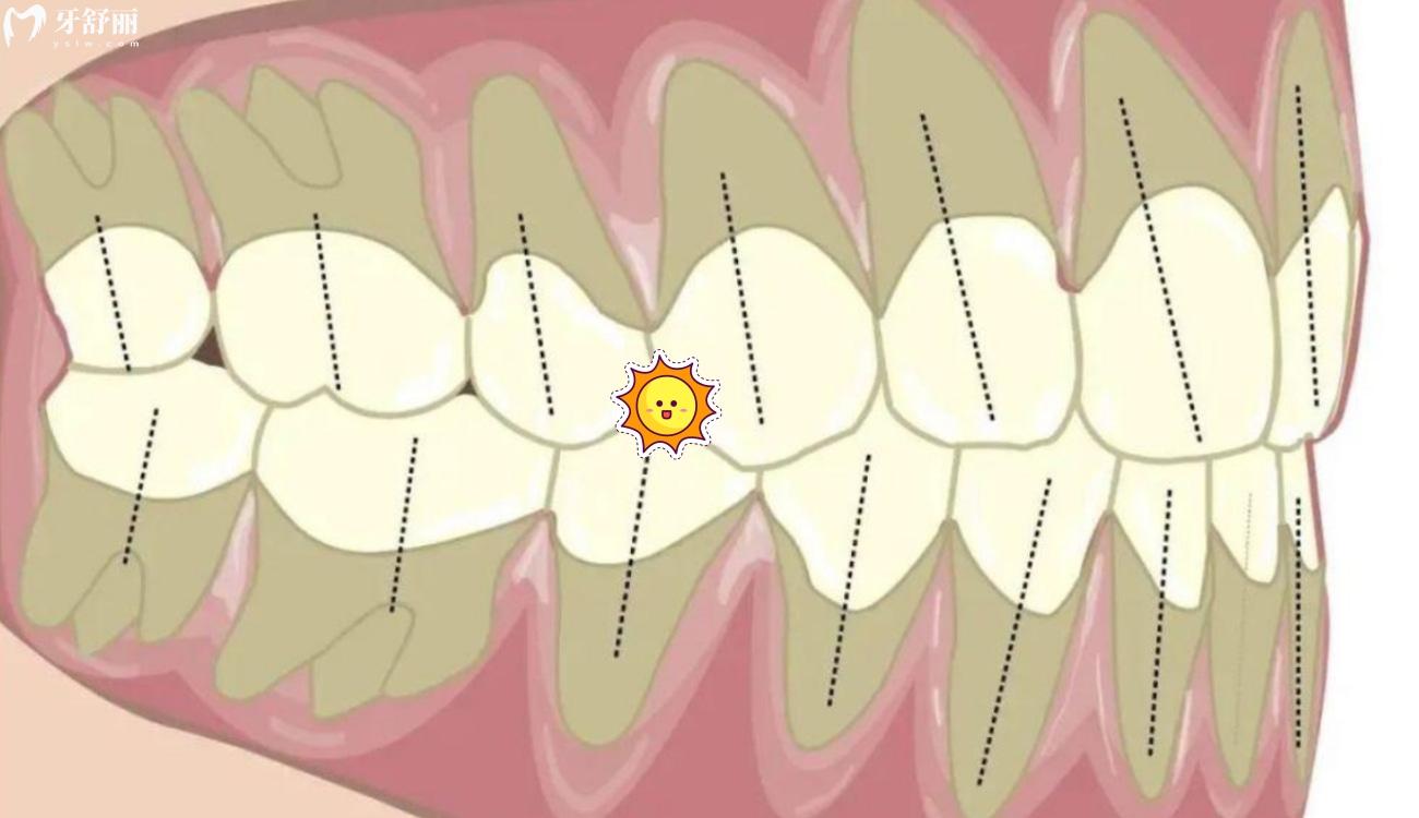 平常牙齿是合的还是不合的?.jpg 平常牙齿是合的还是不合的?.jpg