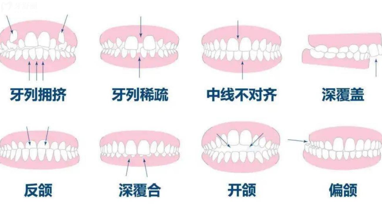 平常牙齿是合的还是不合的?.jpg 平常牙齿是合的还是不合的?.jpg