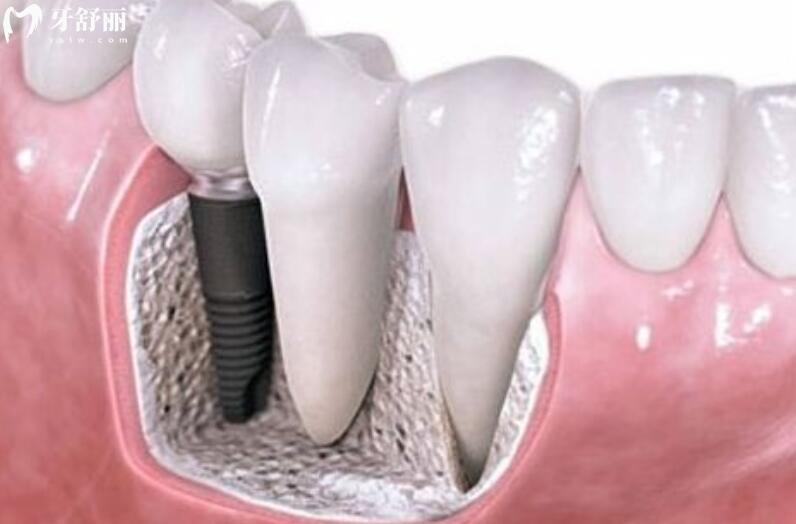 哪些患者不适合做种植牙手术