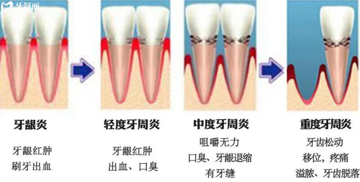 牙周病能治好吗 牙周病能治好吗