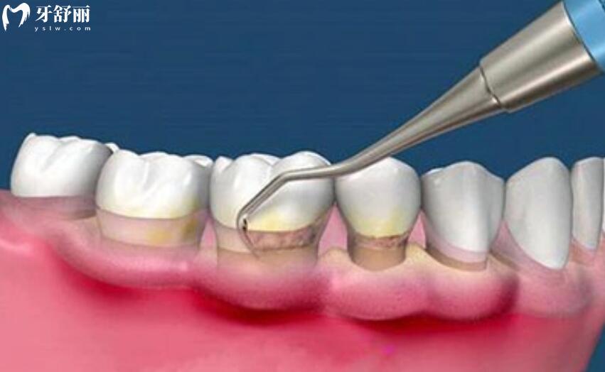 牙周病能治好吗 牙周病能治好吗