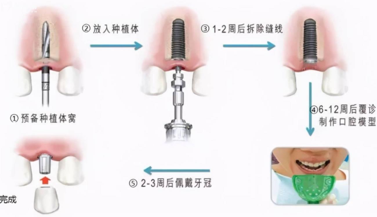 连云港种植牙医院排名.jpg 连云港种植牙医院排名.jpg