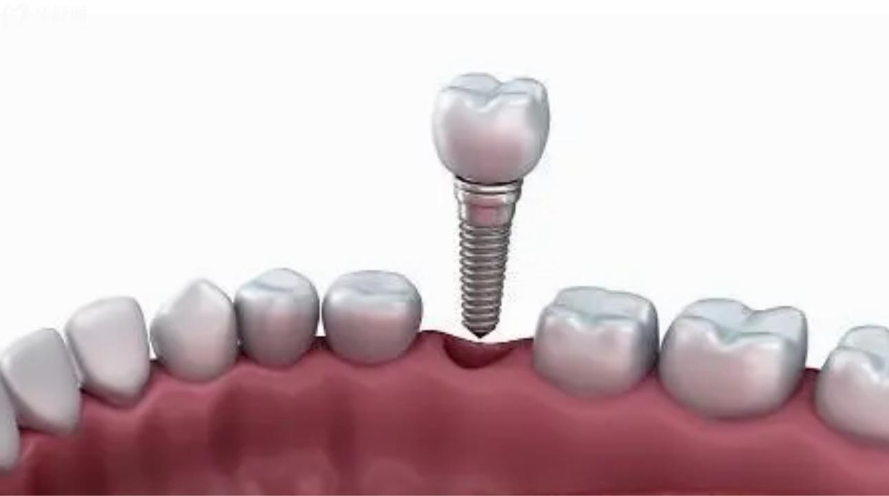 camlog种植牙植体是什么材料?内含价格/使用寿命/型号 camlog种植牙植体是什么材料?内含价格/使用寿命/型号