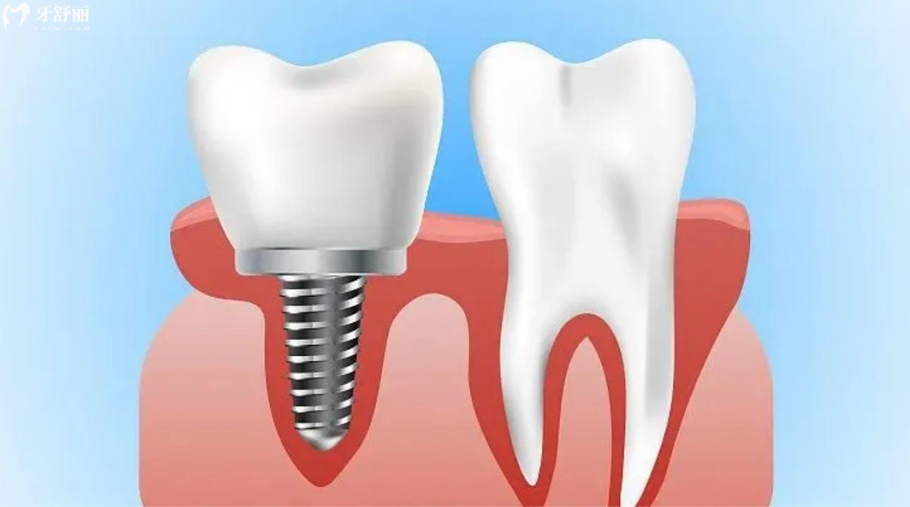 camlog种植牙植体是什么材料?内含价格/使用寿命/型号 camlog种植牙植体是什么材料?内含价格/使用寿命/型号