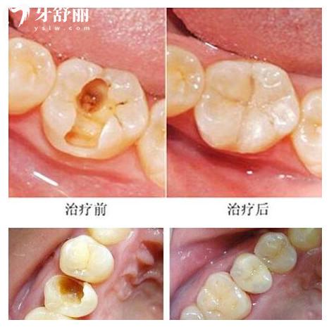 补完的牙齿还会继续蛀牙?!补牙必须要知道的小知识 补完的牙齿还会继续蛀牙?!补牙必须要知道的小知识