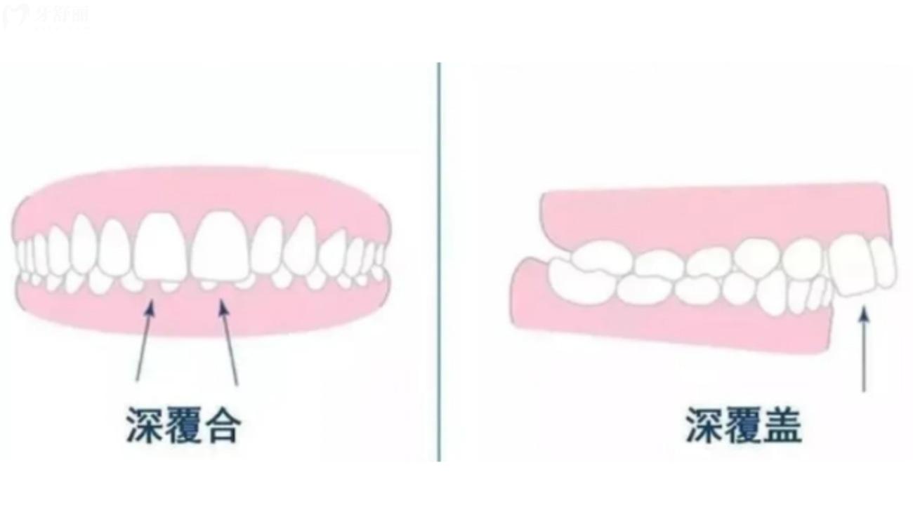 深覆合矫正要多少钱.jpg 深覆合矫正要多少钱.jpg