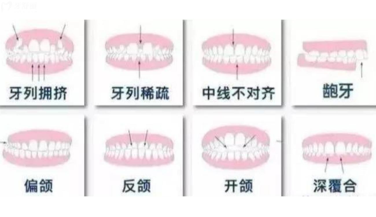 深覆合矫正要多少钱.jpg 深覆合矫正要多少钱.jpg