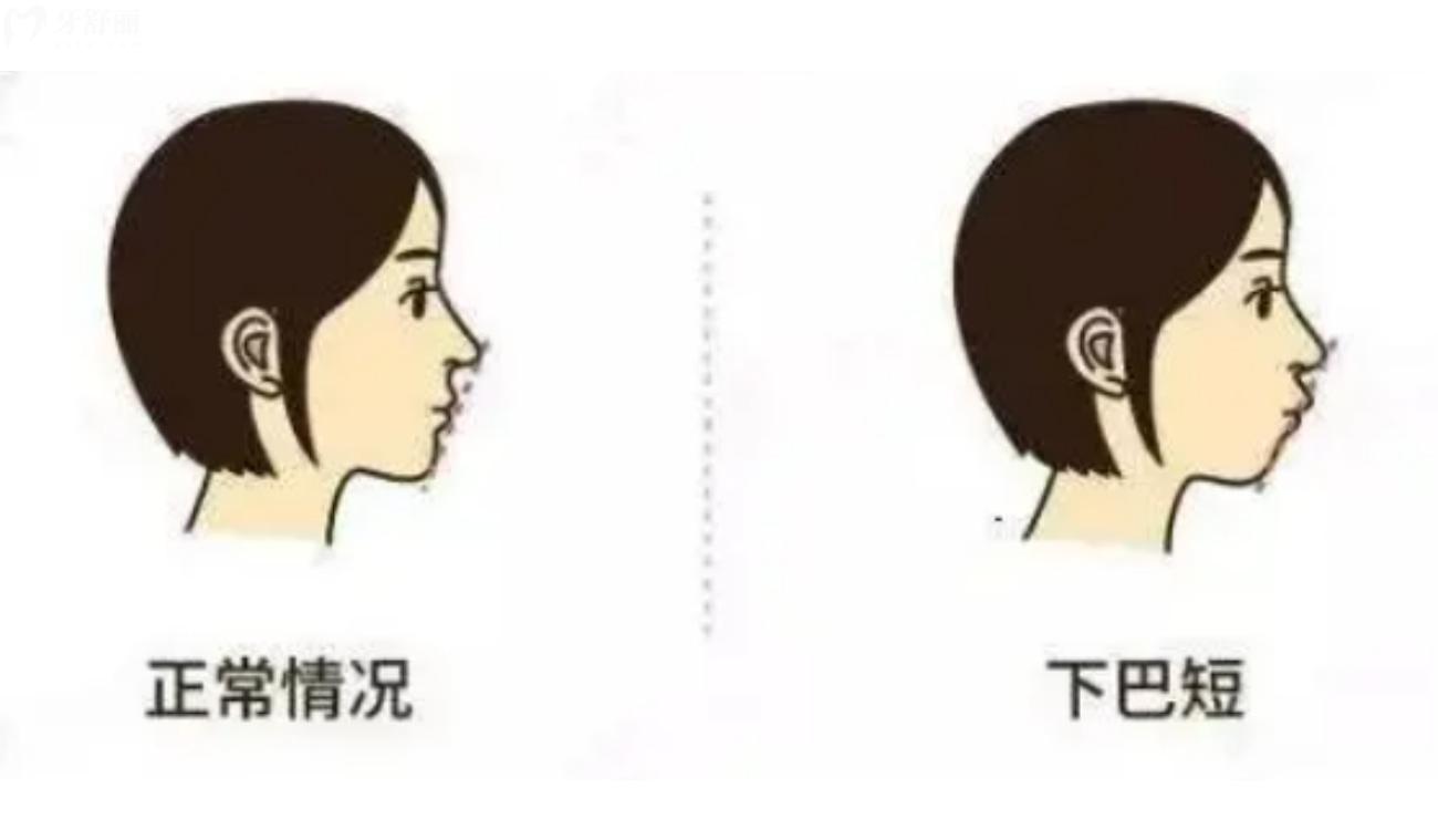 深覆合矫正要多少钱.jpg 深覆合矫正要多少钱.jpg