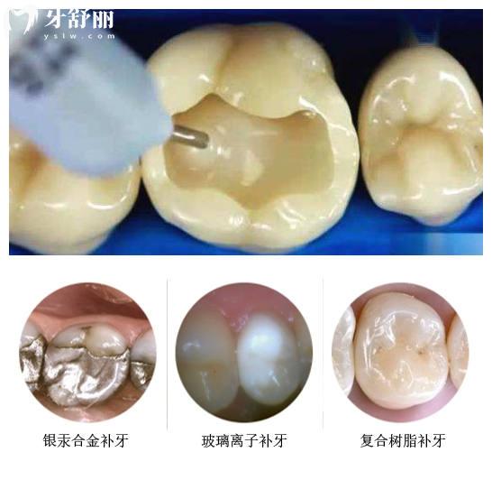 补一颗牙的价格相差几百元,贵的和便宜的材料有什么区别 补一颗牙的价格相差几百元,贵的和便宜的材料有什么区别