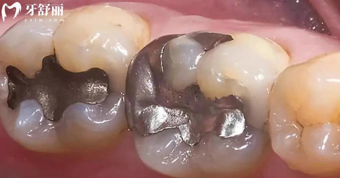 补一颗牙的价格相差几百元,贵的和便宜的材料有什么区别 补一颗牙的价格相差几百元,贵的和便宜的材料有什么区别