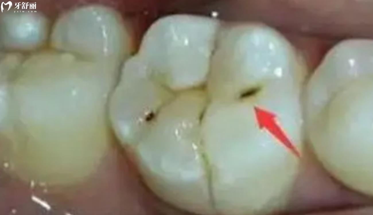 浅蛀牙和色素沉着图片.jpg 浅蛀牙和色素沉着图片.jpg