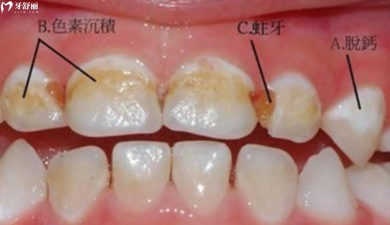 浅蛀牙和色素沉着图片.jpg 浅蛀牙和色素沉着图片.jpg