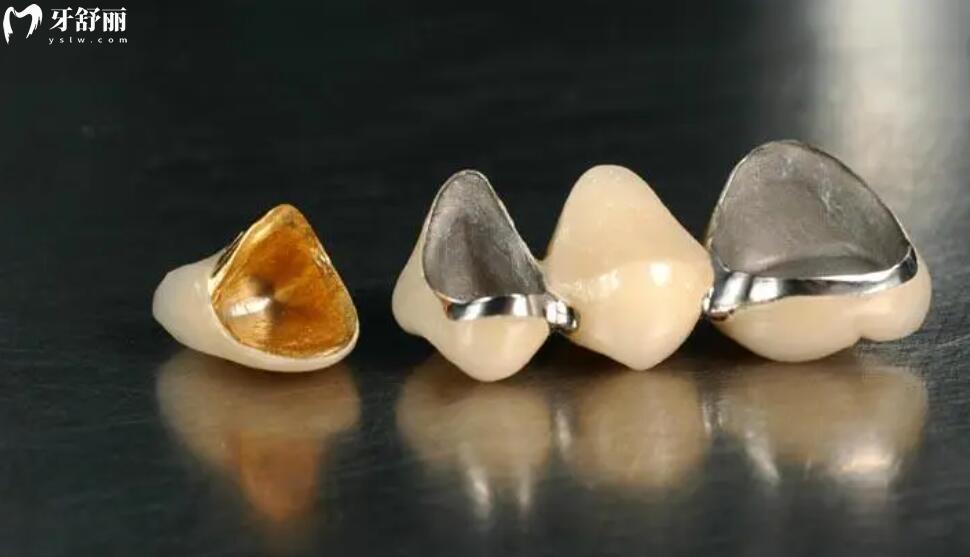 牙冠修复多少钱一颗 牙冠修复多少钱一颗