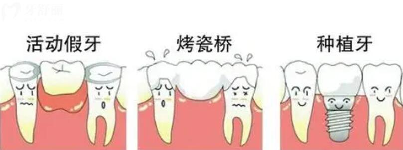 义齿和假牙的区别 义齿和假牙的区别