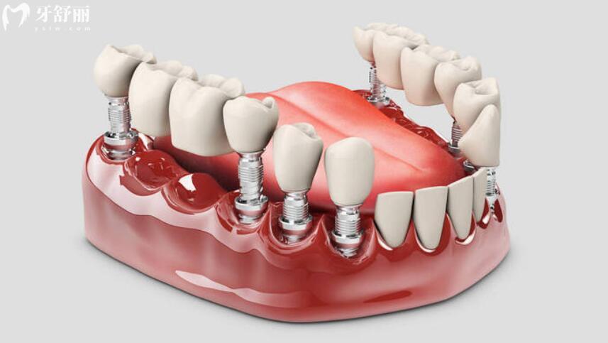 义齿和假牙的区别