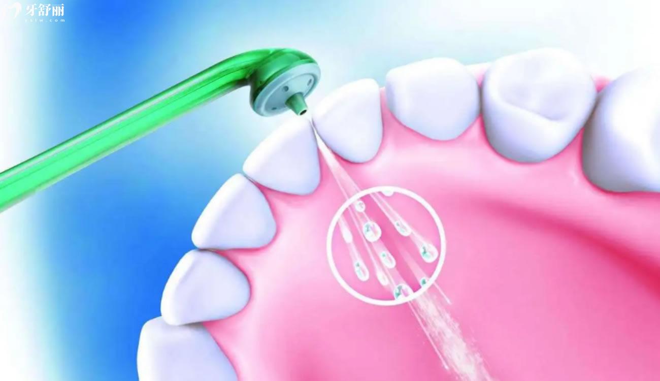 洗牙80元和200元的区别.jpg 洗牙80元和200元的区别.jpg