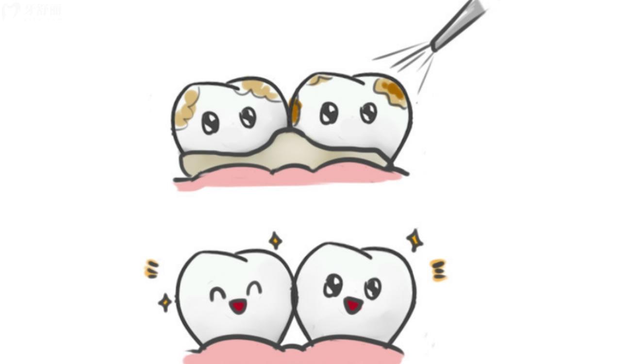 洗牙80元和200元的区别.jpg 洗牙80元和200元的区别.jpg