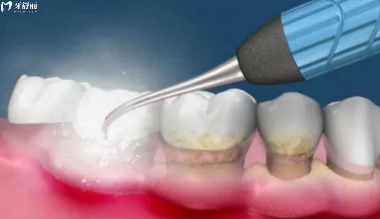 洗牙80元和200元的区别.jpg 洗牙80元和200元的区别.jpg