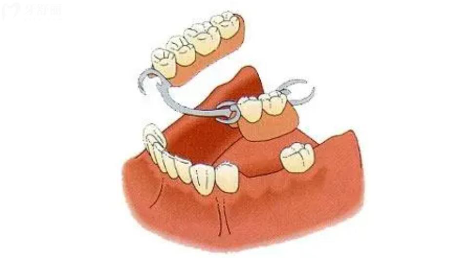 吸附性义齿可以只做半口吗 吸附性义齿可以只做半口吗