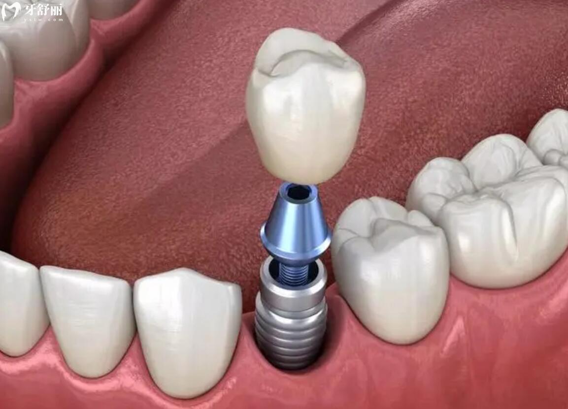 种植一颗牙需要多长时间完成？种植时间都受哪些因素影响？