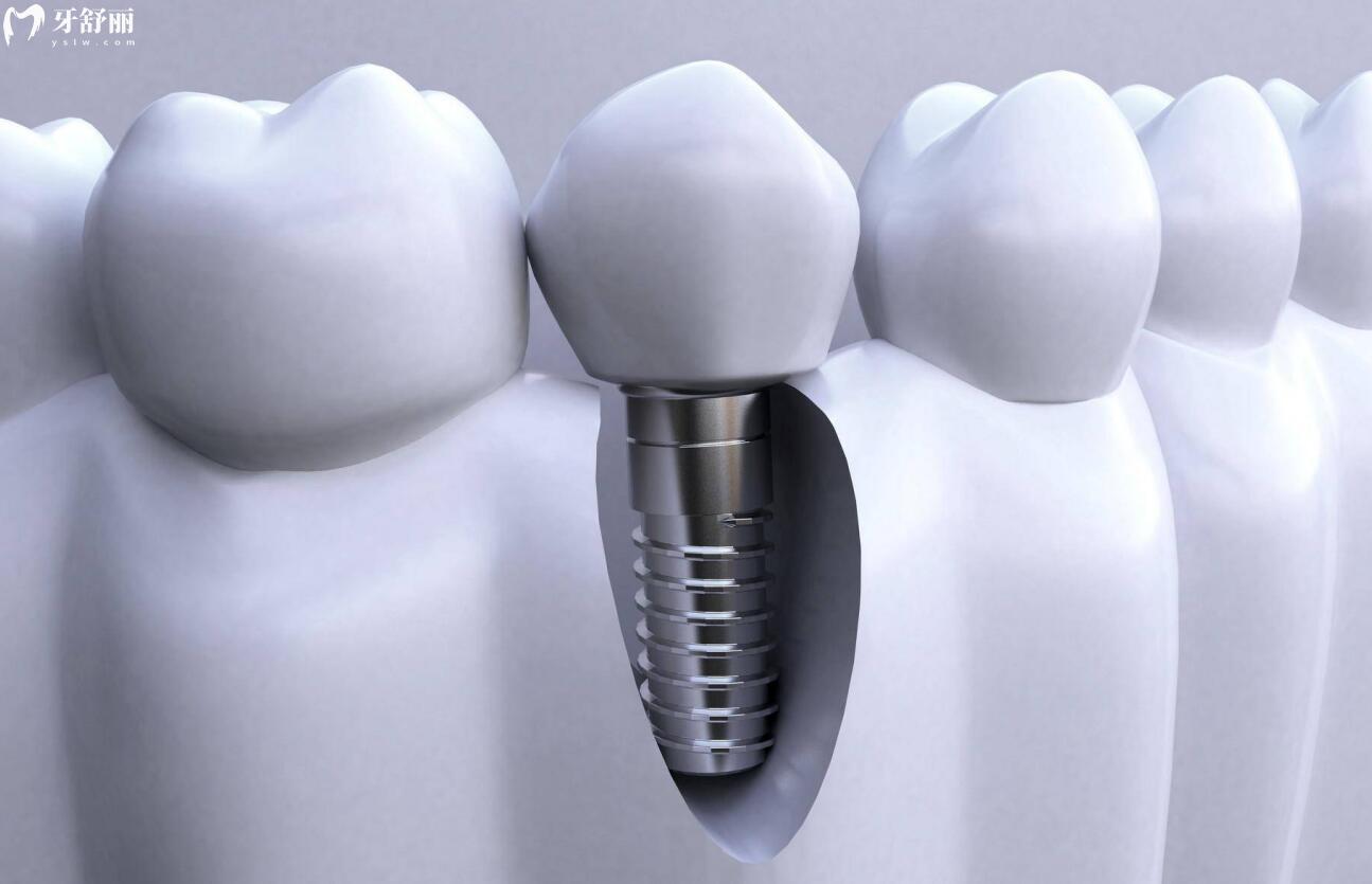 种植一颗牙需要多长时间完成?种植时间都受哪些因素影响? 种植一颗牙需要多长时间完成?种植时间都受哪些因素影响?