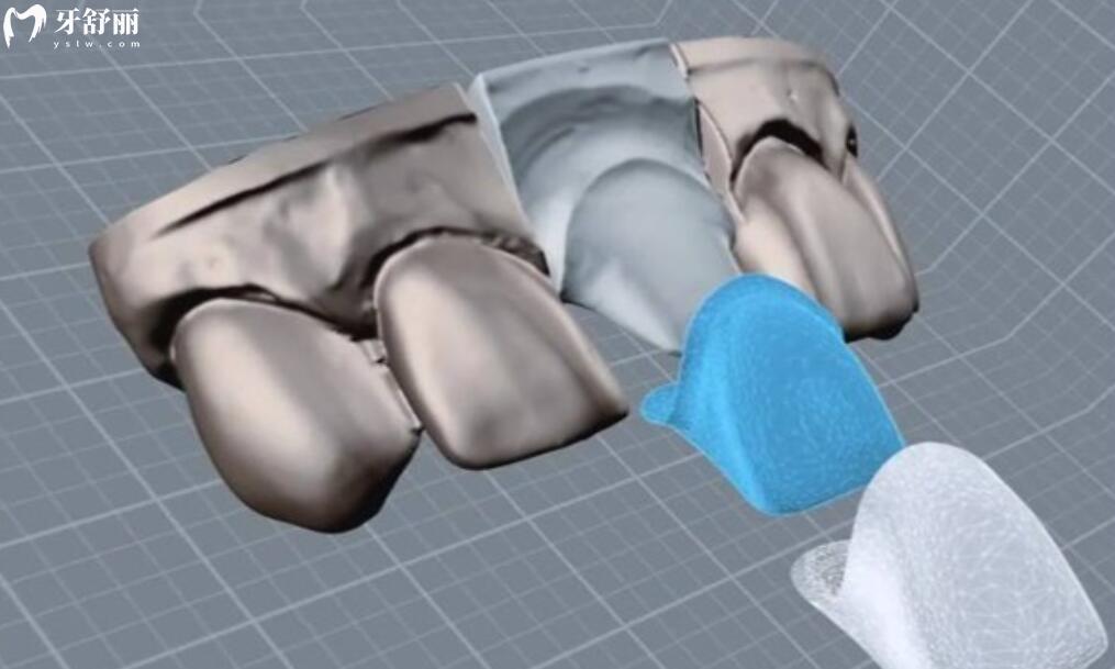 美国3M拉瓦全瓷牙