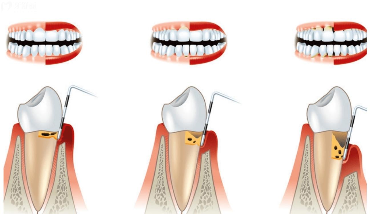 牙周炎刮治多少钱.jpg 牙周炎刮治多少钱.jpg