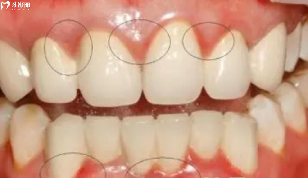 牙周炎刮治多少钱.jpg 牙周炎刮治多少钱.jpg