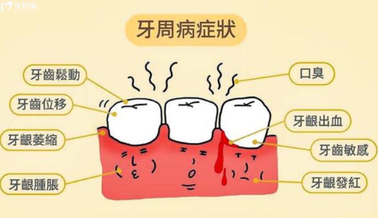 牙周炎刮治多少钱.jpg 牙周炎刮治多少钱.jpg