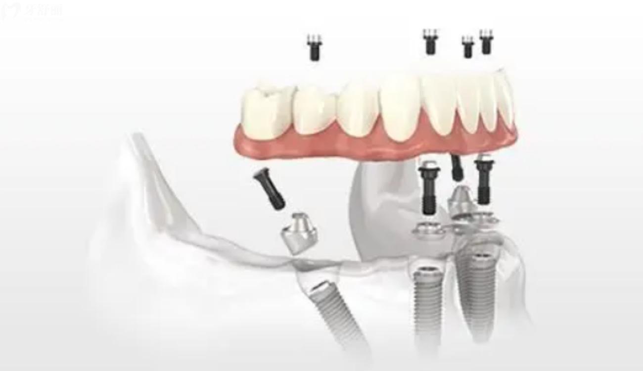 30多岁全口假牙还能活吗.jpg 30多岁全口假牙还能活吗.jpg