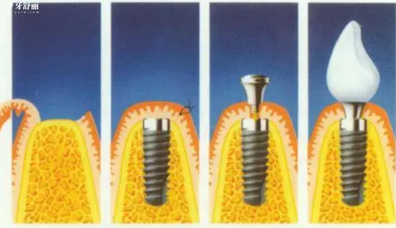 30多岁全口假牙还能活吗.jpg 30多岁全口假牙还能活吗.jpg