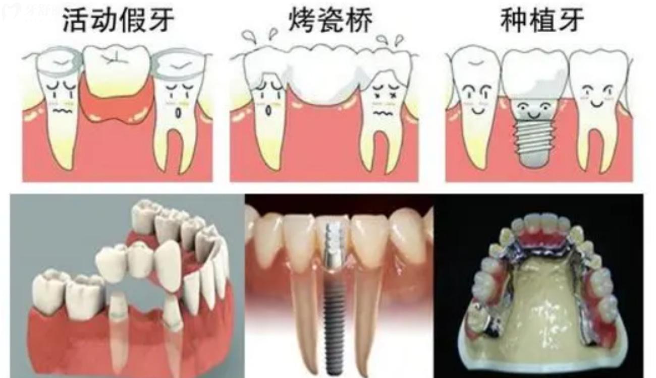 30多岁全口假牙还能活吗.jpg 30多岁全口假牙还能活吗.jpg