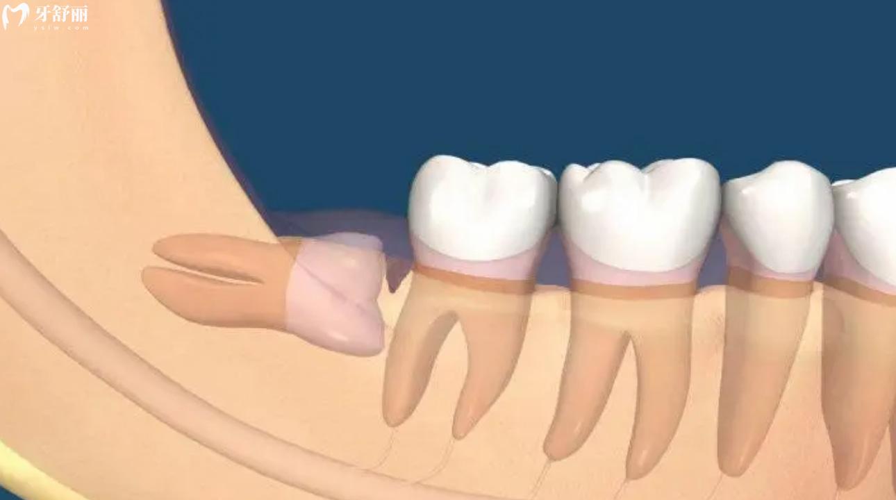 智齿蛀空了会自己掉吗?智齿蛀空了不拔掉会怎么样? 智齿蛀空了会自己掉吗?智齿蛀空了不拔掉会怎么样?